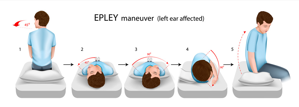 vertigo-epley-manevrası