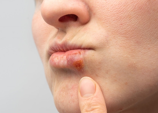 Herpes (Uçuk) Virüsü Nedir? Tedavisi Nasıldır?