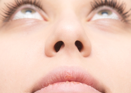 Nazal Septum Perforasyonu Nedir?